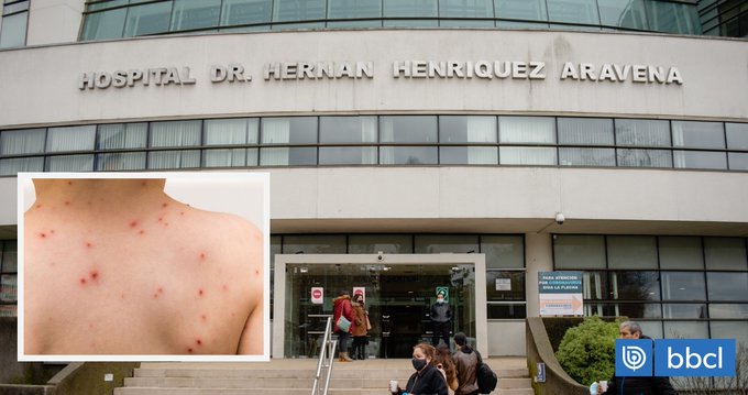 Abren sumario sanitario por casos graves de varicela en Tirúa: hay 2 estudiantes en riesgo vital.